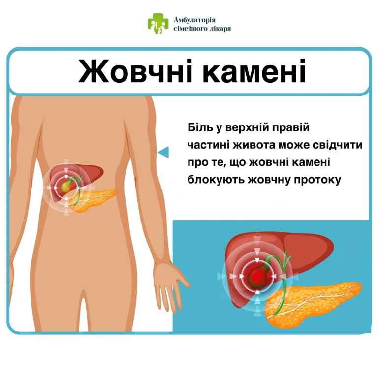 Як виглядає гормональний живіт: ключові ознаки та відмінності